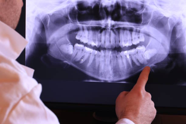 Best Knocked-Out Tooth (Avulsed Tooth) Treatment in Buhler, KS