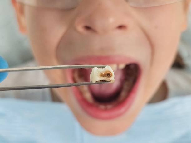 Best Dental Abscess Treatment in Buhler, KS